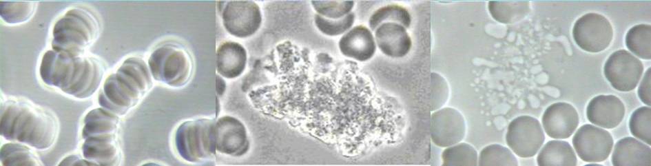 Unhealthy Red Blood Cells
